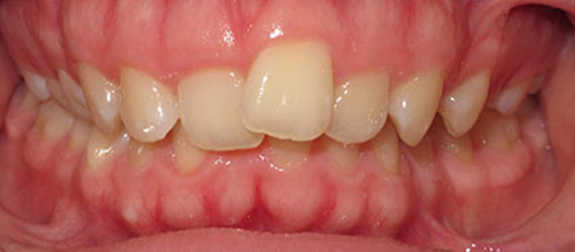 Clear braces, Specialist Orthodontist In Pakenham