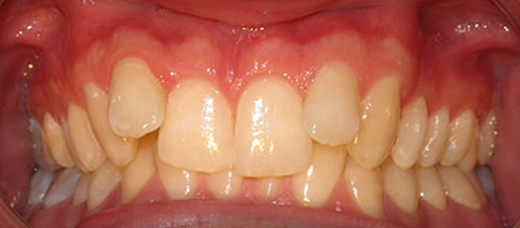 Clear braces, Specialist Orthodontist In Pakenham